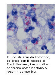 Mycobacterium tuberculosis